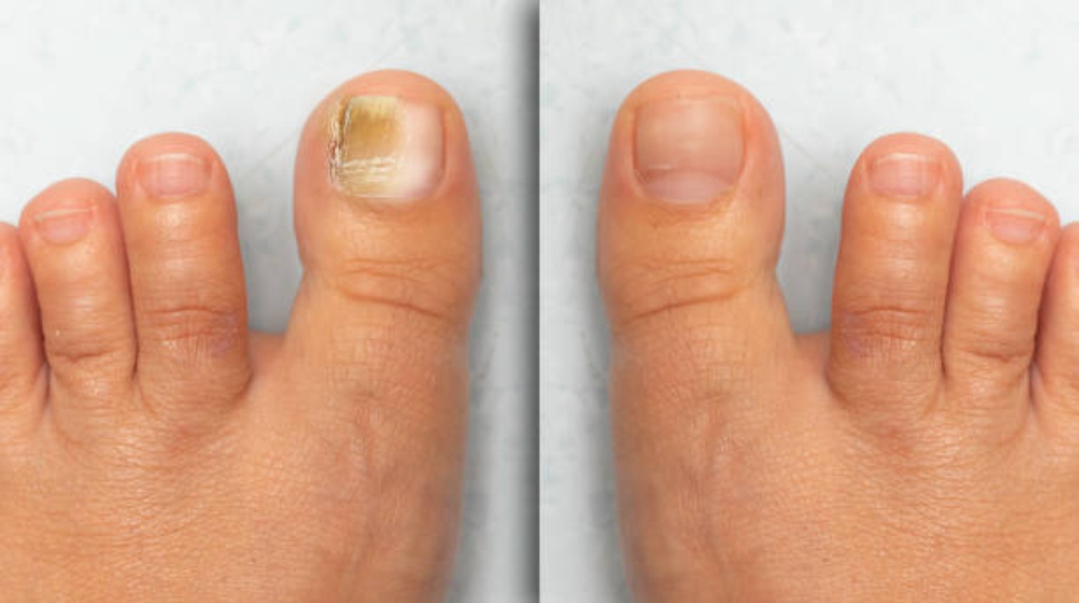 Fungal Nails category